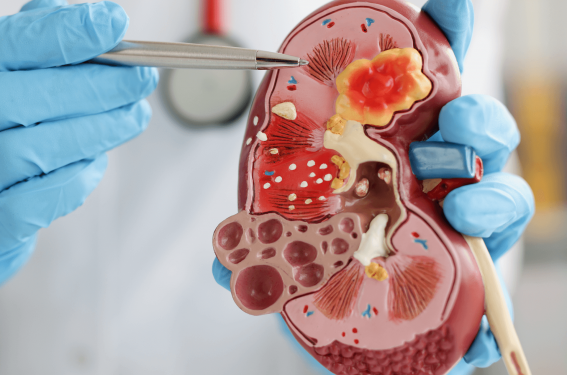 Maladie rénale chronique et diabète de type 2 - Partie 1 • Histologie,  pathogénie et stades évolutifs