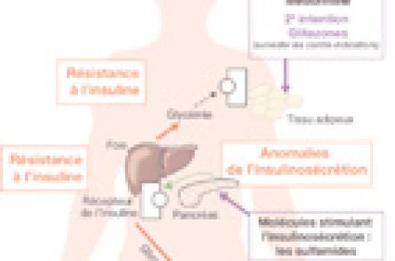 Diabète : une nouvelle anti-sucre découverte 